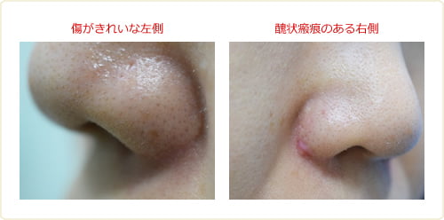 小鼻縮小（外側切除）後の傷跡の修正