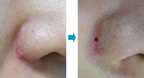 小鼻縮小（外側切除）後の傷跡の修正