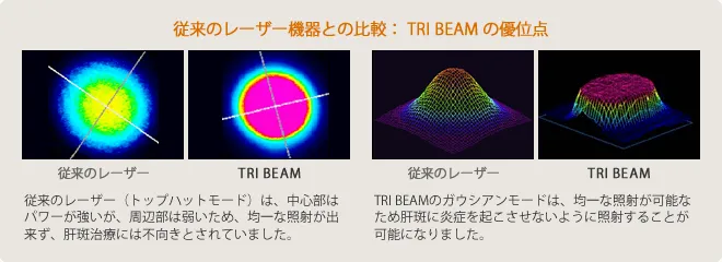 従来のレーザー機器との比較：TRI BEAMの優位点
