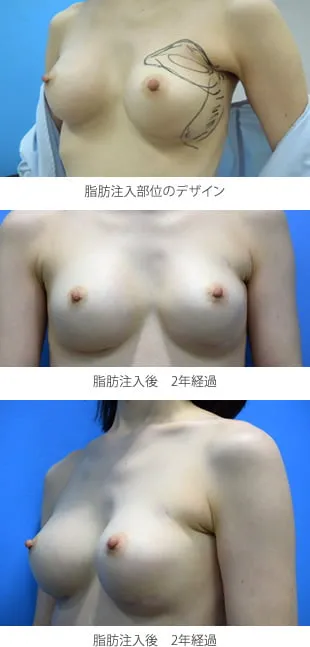形を整える目的に、左上胸部と外側部に脂肪注入