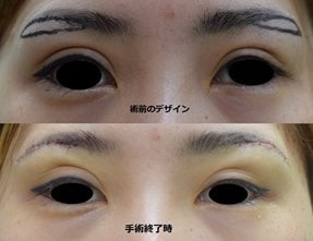 二重整形 手術のご相談は大阪の医療法人秀晄会 コムロ美容外科へ