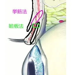 埋没法の瞼板法or挙筋法、挙筋瞼膜法