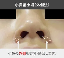 小鼻縮小術（外側法）