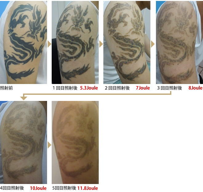 刺青 タトゥー除去 美容整形 美容皮膚科のご相談は医療法人秀晄会 コムロ美容外科へ