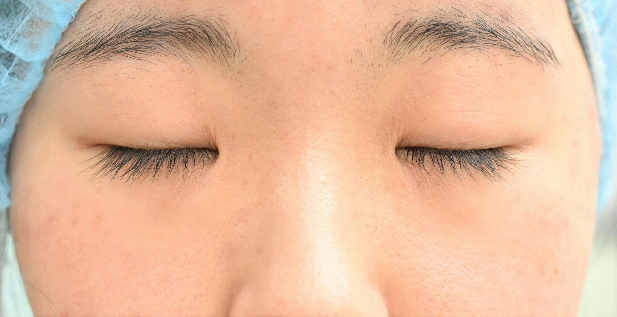 10代女性　目頭切開+全切開法　一重から自然な平行型に・・・