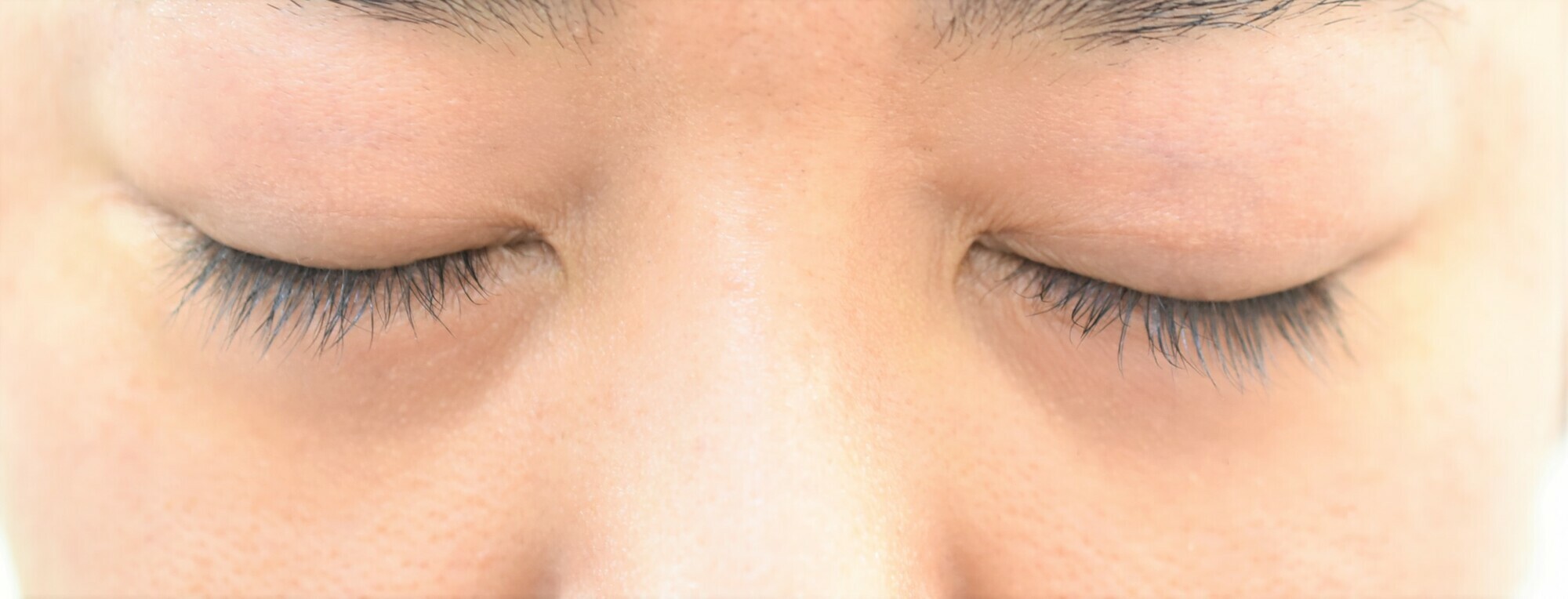 20代男性　下眼瞼脱脂　結膜側
