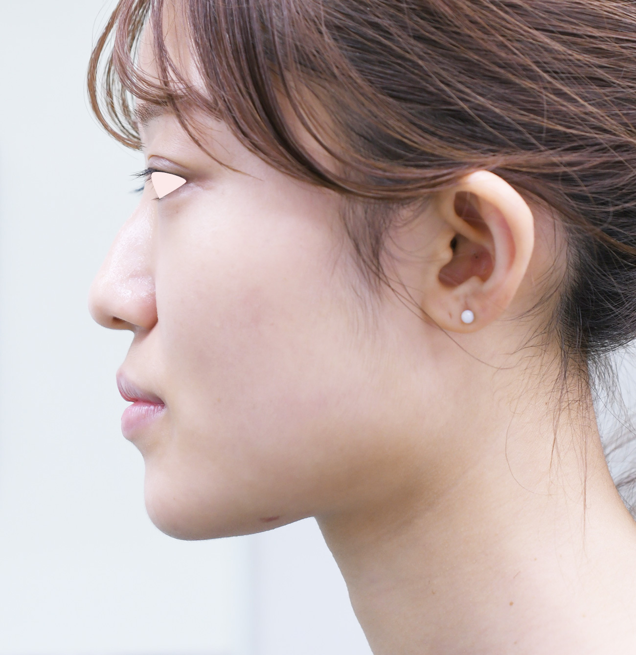 20代 女性 顎骨切り 池内医師