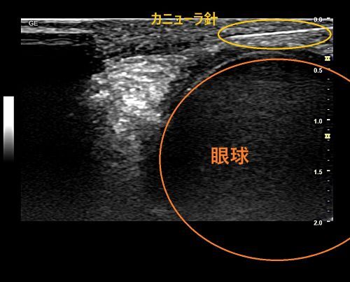 上まぶた超音波エコーを当てながらカニューラを使ってヒアルロニダーゼ注射
