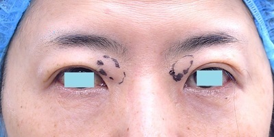 術前　開眼