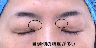 術前　閉眼