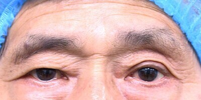 片目二重整形全切開症例_術前