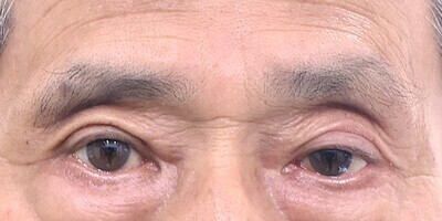 片目二重整形全切開症例_術後1ヶ月