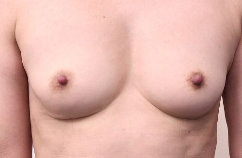 アクアフィリング除去症例_1ヶ月後