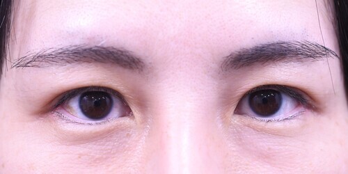 目尻切開症例_術後1か月