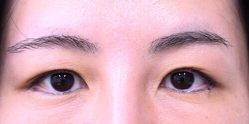 目尻切開症例_術後抜糸