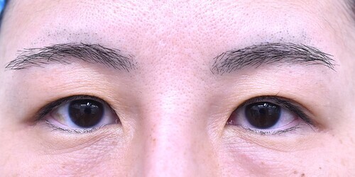 目尻切開症例_術前