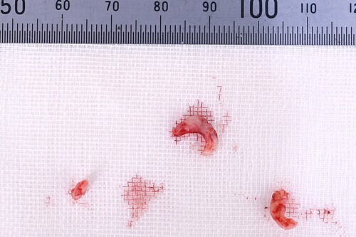 舌ピアス肉芽切除した組織