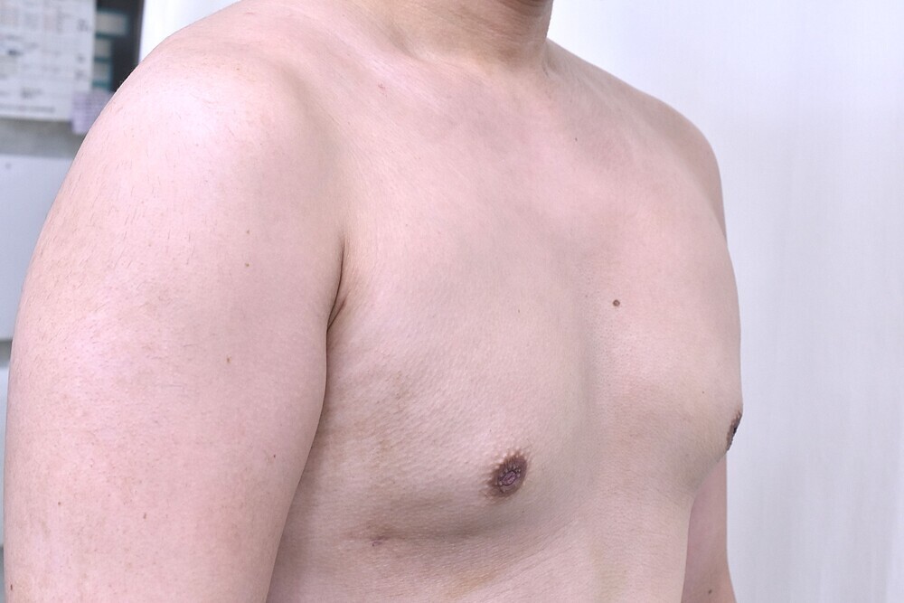 女性化乳房治療_術後1ヶ月斜め