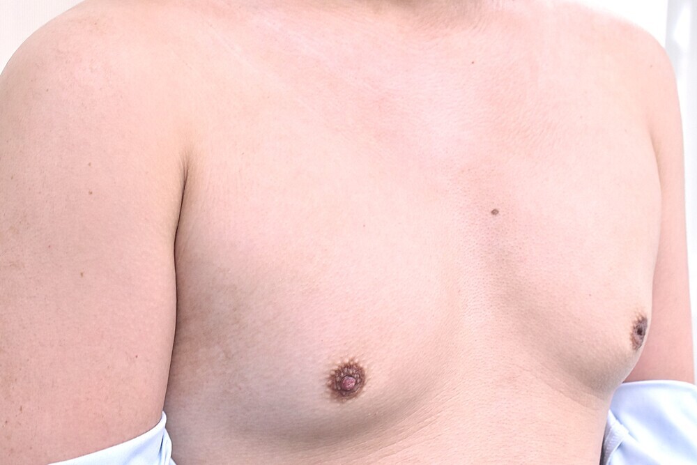 女性化乳房治療_術前斜め