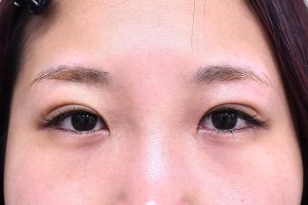 20代女性埋没法症例_術後