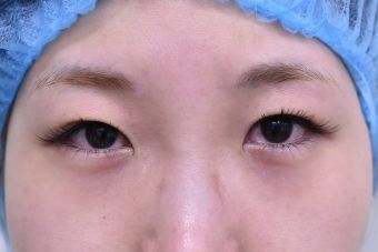 20代女性埋没法症例_術前