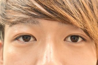 20代男性埋没法症例_術後