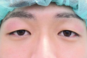 20代男性埋没法症例_術前