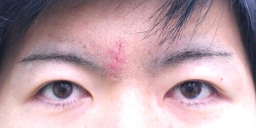 眉間しわ切除症例_術後1週間