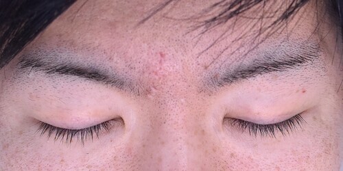 眉間しわ切除症例_術後3ヶ月