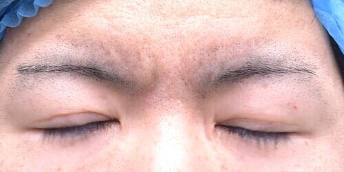 眉間しわ切除症例_手術前