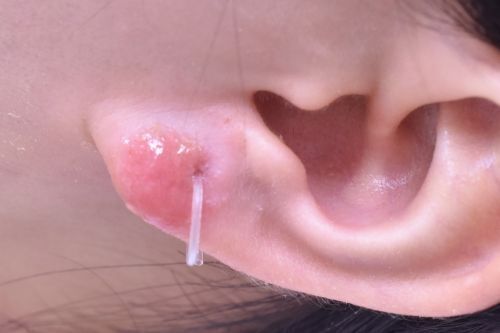 金属アレルギーの症例1_施術後