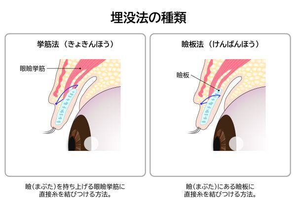 埋没法の種類