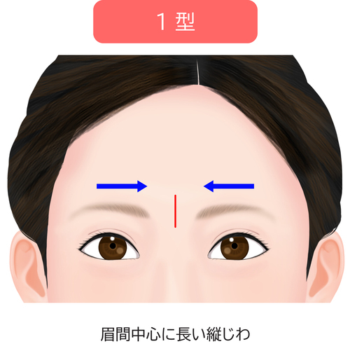 眉間のシワ1型
