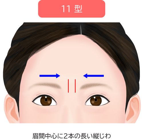 眉間のシワ11型