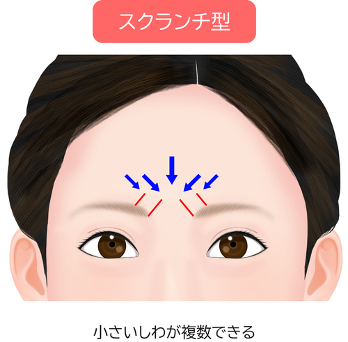 眉間のシワスクランチ型