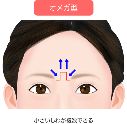 眉間のシワオメガ型