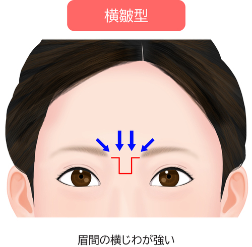 眉間のシワ横皺型