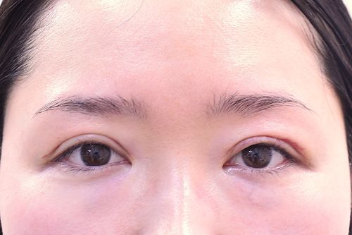 ハム目ダウンタイム経過_術後1ヶ月
