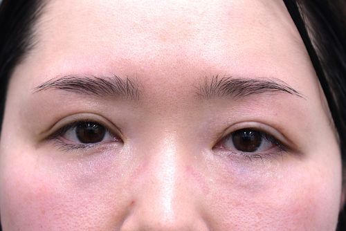 ハム目ダウンタイム経過_術後2ヶ月