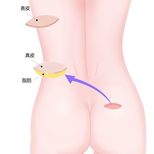 真皮脂肪移植