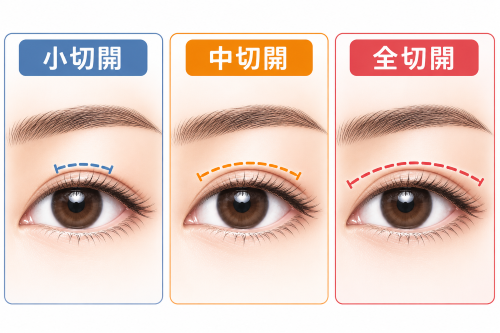 切開法の3種類