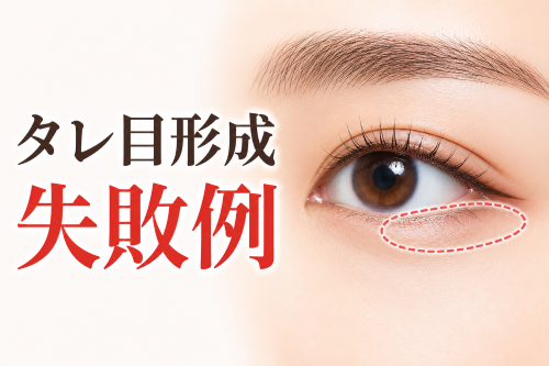 タレ目形成の失敗例
