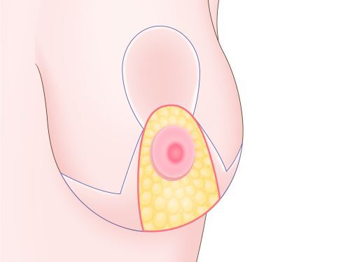 乳房縮小術イラスト