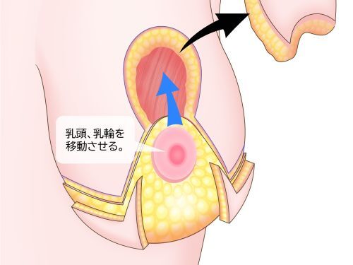 乳房縮小術イラスト2