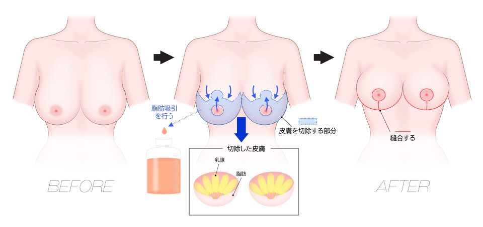逆T字切開