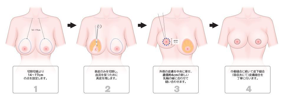 乳輪周囲切開