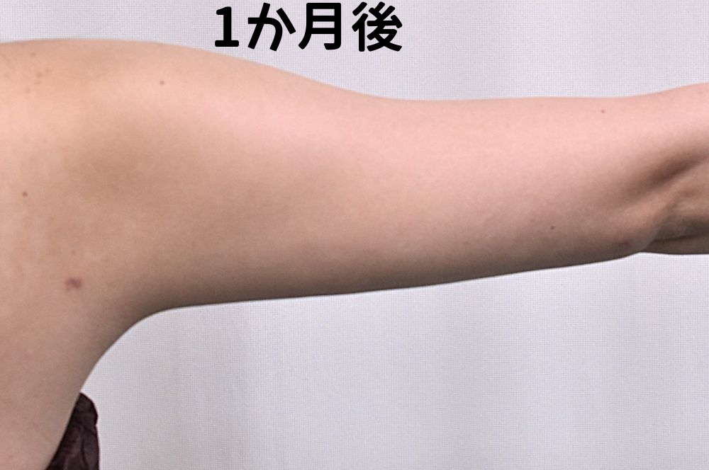 二の腕脂肪吸引術後_1か月