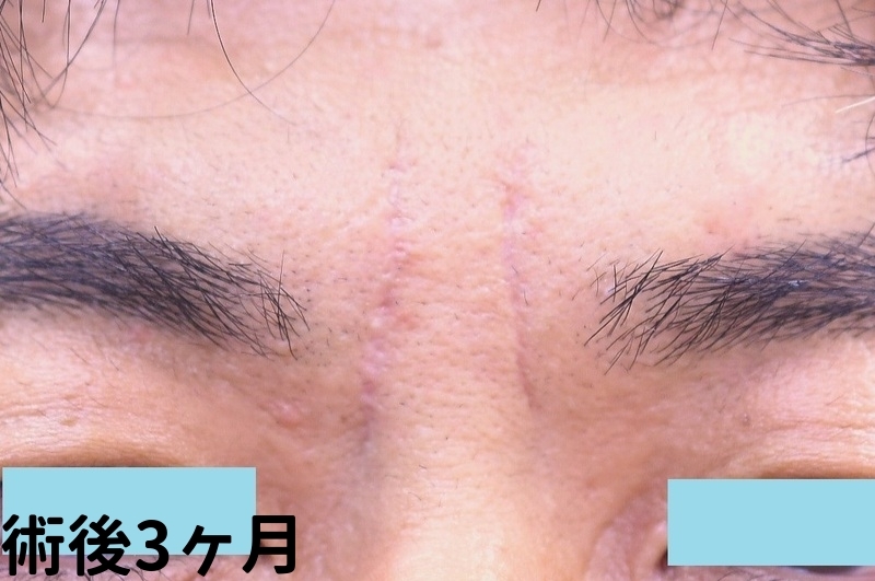 眉間のしわ症例_術後3ヶ月