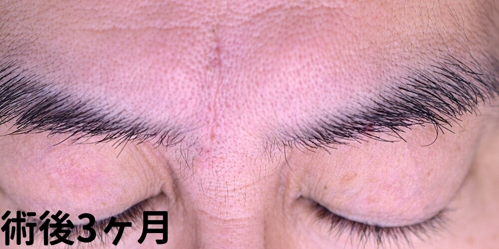 眉間のしわ切除症例_術後3ヶ月