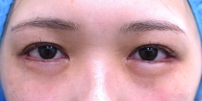 目上切開症例_術前